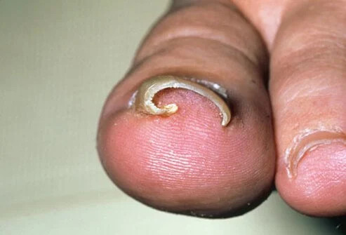 Cantengan (Ingrown Nail)